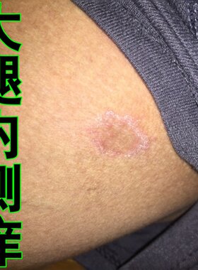 大腿内侧真菌性痒外用软膏男性皮肤感染起小红点疙瘩潮湿修复膏