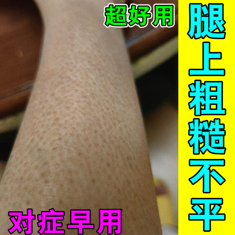 胳膊上的小疙瘩红点去手臂毛囊毛皮肤消毒护理（消）