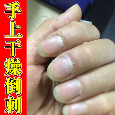 手指上倒刺修复手指甲边缘去死皮干裂开裂硬皮粗糙肉刺疼