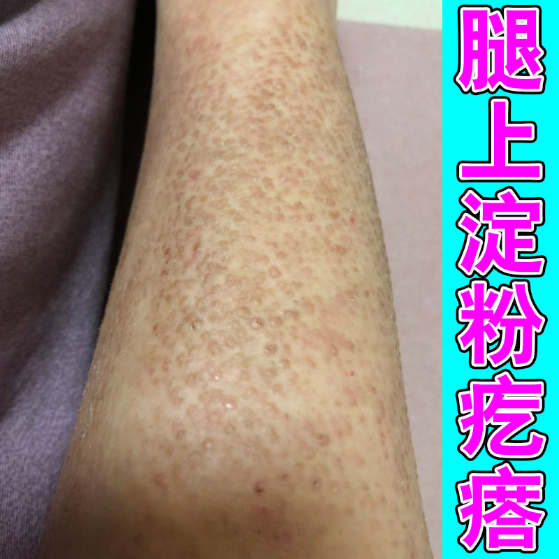 腿上褐色粗糙疙瘩痒药皮肤干痒
