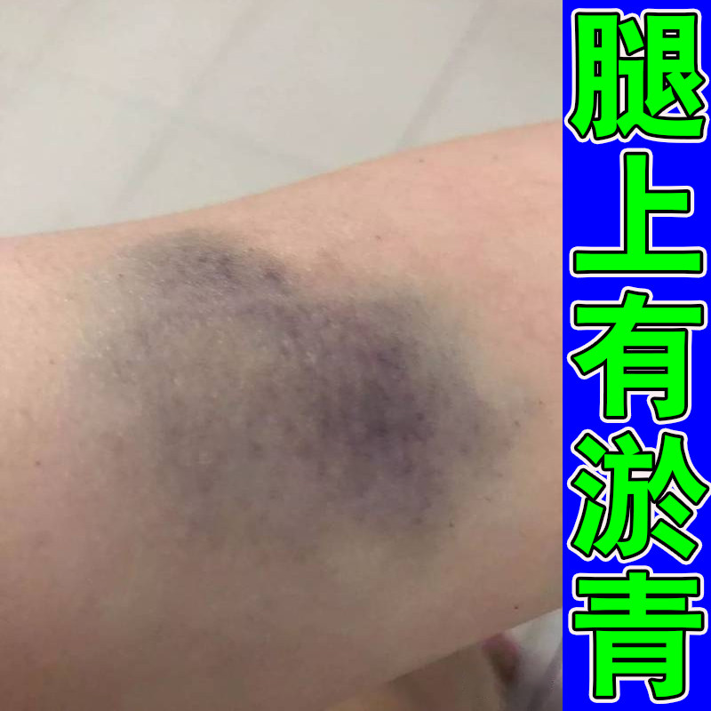 腿部有淤青软膏身上撞伤发紫红肿跌打损伤腿上淤青皮下青紫