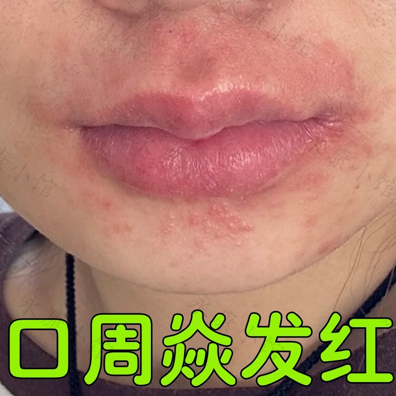 口周发炎嘴巴红一圈干燥紧绷剥脱唇发炎真菌感染肉芽肿性结痂唇膏