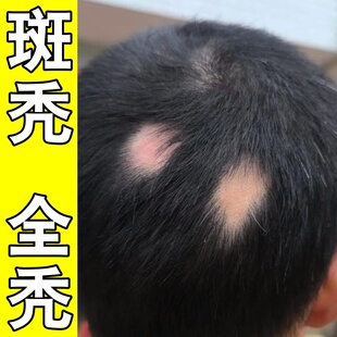 鬼剃头谢顶秃顶防脱突发斑性秃营养液特鬼剃头特育发效生姜发根液
