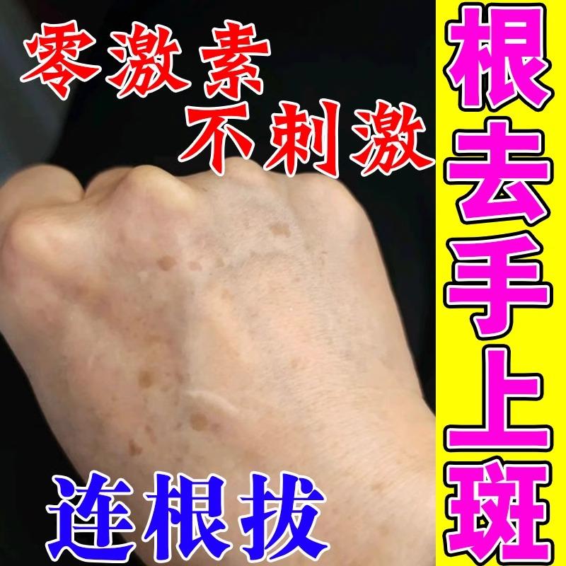 手上老年斑强力去除手部祛斑手背晒黑斑黄褐斑黑色素沉淀淡斑美白