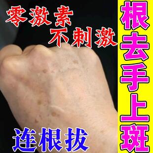 手上老年斑强力去除手部祛斑手背晒黑斑黄褐斑黑色素沉淀淡斑美白