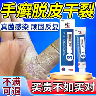 手癣膏脱皮干裂真菌感染严重专用蜕皮干燥起皮手指鹅掌风角化型KD
