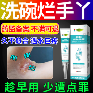 洗碗烂手丫碰水手指缝溃烂痒专用脱皮开裂口疼痛止痒膏药房同售VV