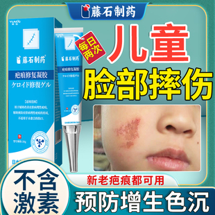 祛疤膏儿童专用小孩脸部摔伤修复膏擦伤疤痕除疤膏去黑色素沉淀KD