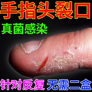 手指头真菌感染手癣膏脱皮干裂去手足癣裂口子湿疹药监备案KD