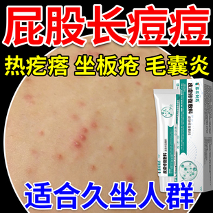 藤石制药屁股上长痘痘痒起热疙瘩久坐板疮长疙瘩长火疖子毛囊炎KD