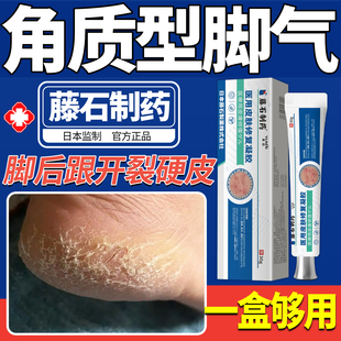 角质型脚气脚后跟干裂真菌感染角化型专用乳膏起硬皮足跟开裂KD