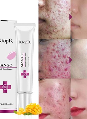 RtopR 15g Natural Mango Extract Face Acne Remover Cream Acne