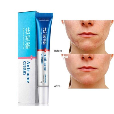 Comedone Pimple Anti Acne Treatment Acne Scar Blackhead Remo