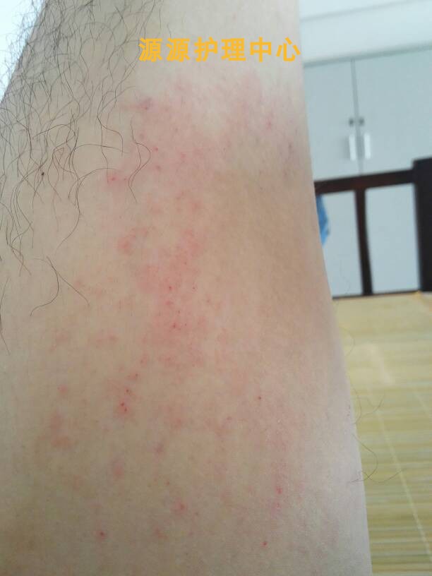 运动出汗皮肤痒起鸡皮疙瘩(运动后皮肤发痒起疙瘩怎么办) 运动出汗皮肤痒起鸡皮疙瘩(运动后皮肤发痒起疙瘩怎么办)