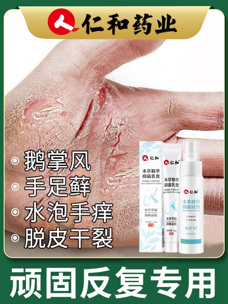 鹅掌风手癣膏脱皮干裂真菌感染手痒手气烂手丫专用药手裂手藓药膏