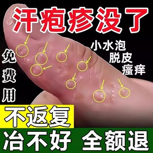 汗泡疱疹膏手上起小水泡汗状疱疹止痒真菌感染专用软膏湿疹孢疹