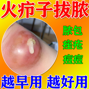 火疖子毒拔拔脓膏后背毛囊炎脓包肿大的屁股上长痘硬疙瘩红肿快膏