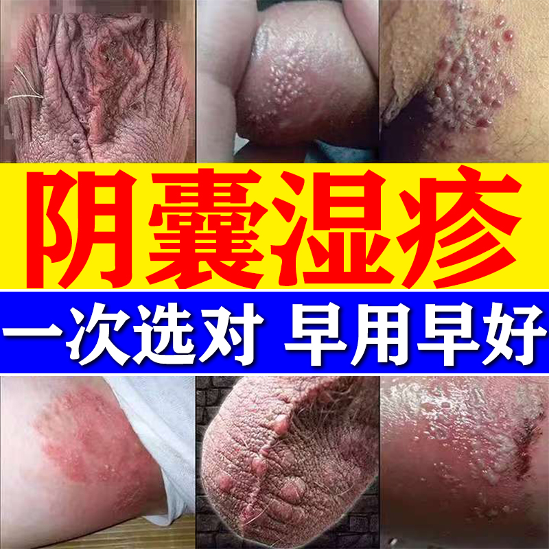 早用早好】阴囊瘙痒湿疹止痒药膏