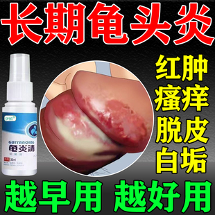 龟头炎喷雾剂真菌感染用专膏男性士霉菌性包皮炎白垢包皮水肿喷剂