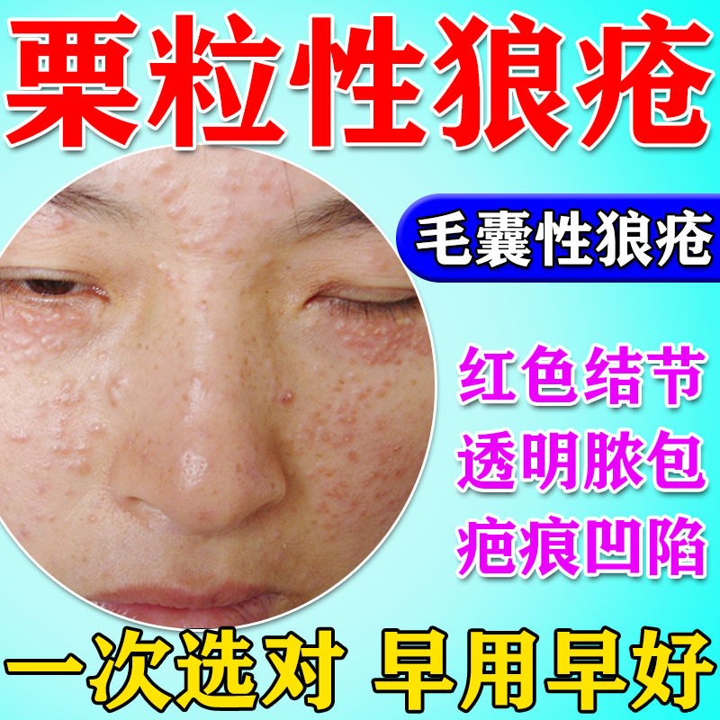 面部栗粒性狼疮修复脸部医用痒红肿结节脓包颜面播散性粟粒性狼疮