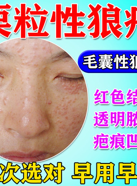 面部栗粒性狼疮修复脸部医用痒红肿结节脓包颜面播散性粟粒性狼疮