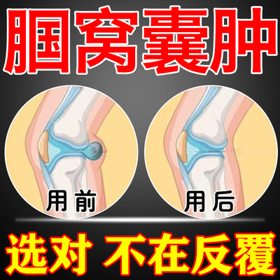 后腿窝筋疼腘窝囊肿药膏