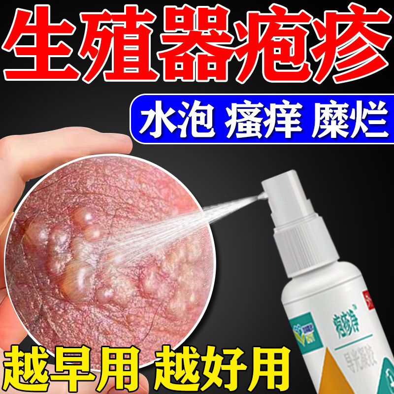 生殖器疱疹净断喷雾克星瘙痒红肿
