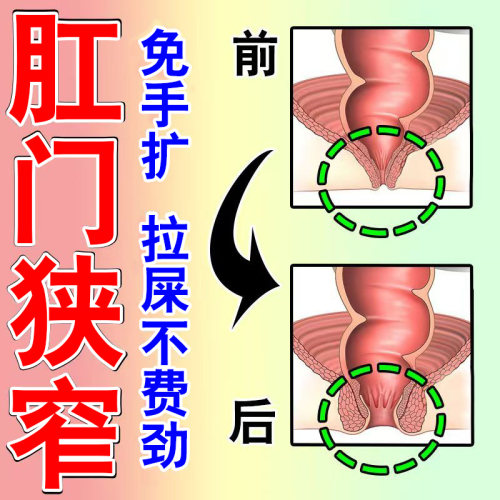 肛门狭窄便秘有肉球痒脱肛裂肛门闭锁大便变细拉不干净有异物感Z