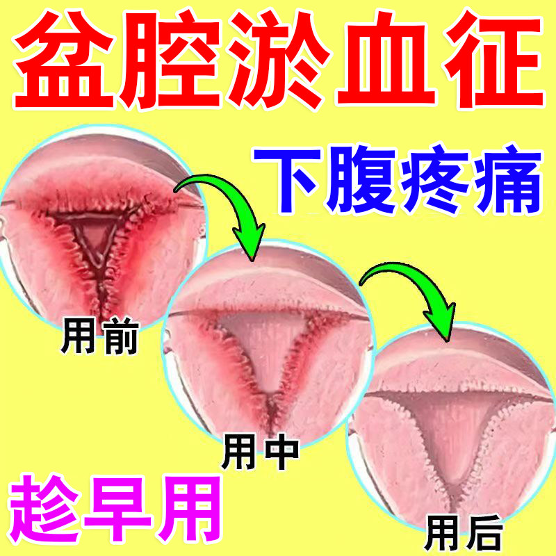 盆腔淤血综合征贴膏盆腔炎盆腔静脉曲张小腹坠痛月经痛白带增多Z