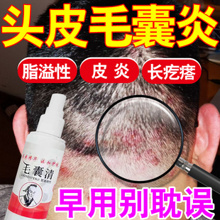 头皮毛囊炎脂溢性皮焱疙瘩头癣藓顽固头皮屑杀菌止痒去屑用专喷剂