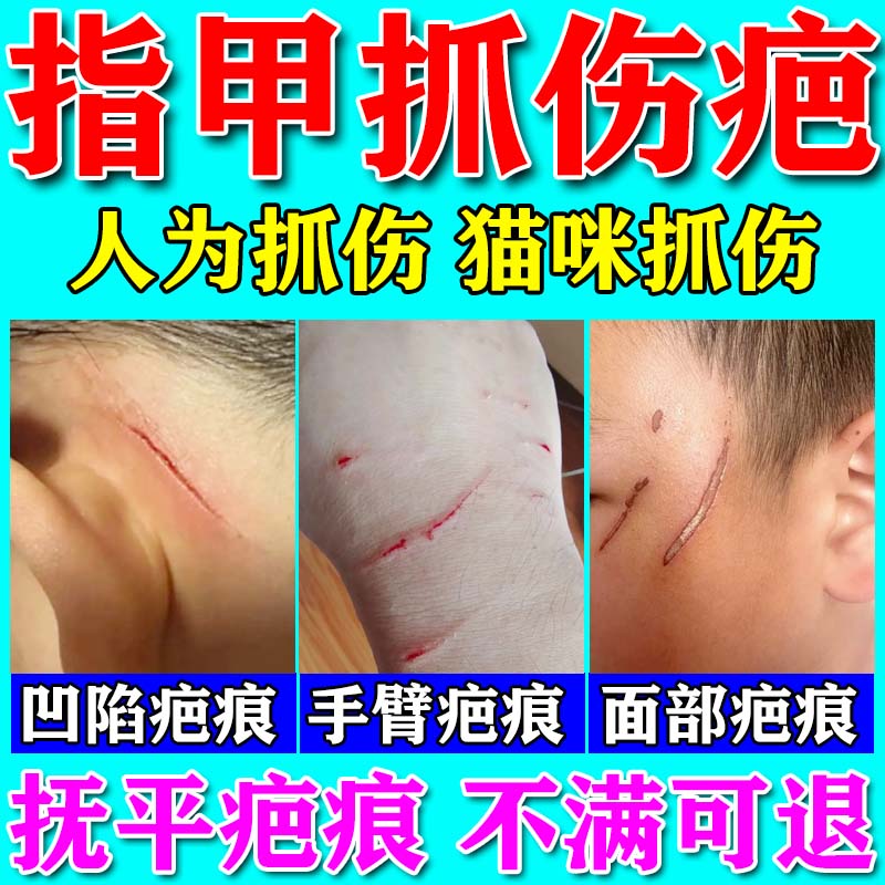 医用硅酮疤痕凝胶祛指甲抓伤疤痕