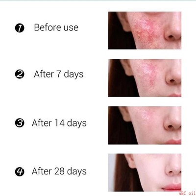 Effective Acne Removal Cream Treatment Acne Scar Spots Cream