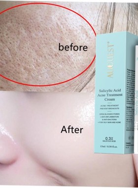 Salicylic Acid Acne Treatment Face Cream Anti-acne Gel Shrin