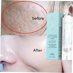 Salicylic Acid Acne Treatment Face Cream Anti-acne Gel Shrin