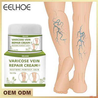 Varicose Veins Cream Varicose Vein Treatment Cream For Legs