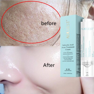 Salicylic Acid Acne Treatment Face Cream Anti-acne Gel Shrin