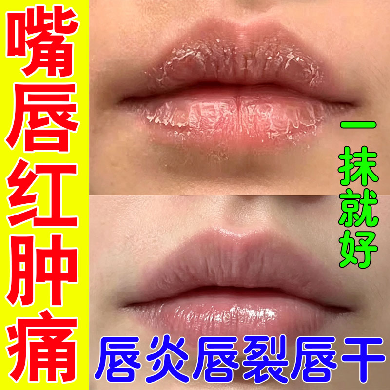 唇脱焱唇膏干嘴唇皮裂嘴角嘴唇痛复烂修膏保湿滋润嘴唇厚外改善翻