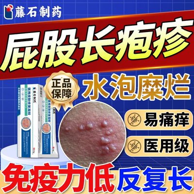 臀部单纯带状疱疹引起屁股反复红水泡溃烂疼痛搭大师贴药房同售QN