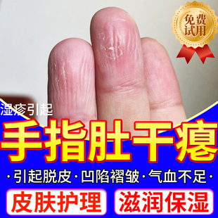 手指肚干瘪脱皮干裂角化型湿疹手癣膏真菌感染手指腹部竖纹褶皱QN