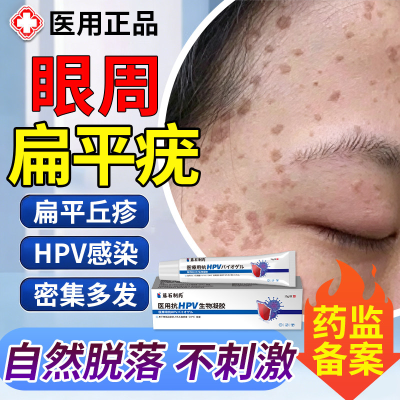 眼周扁平疣去疣瘊眼皮小肉粒面部脸上去疣肉粒疙瘩去除膏一抹灵ZJ