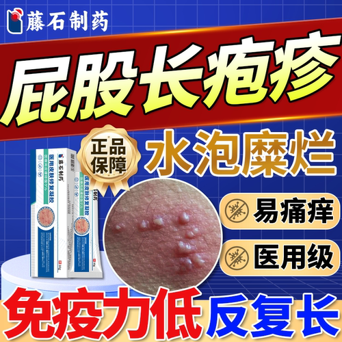臀部单纯带状疱疹引起屁股反复红水泡溃烂疼痛搭大师贴药房同售QN