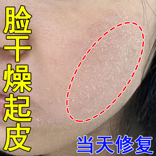 脸上干燥起皮脸部红痒有碎屑过敏皮肤修复补水男女士脸痒脱皮药膏