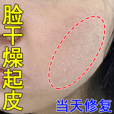 脸上干燥起皮脸部红痒药膏