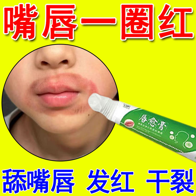 嘴唇周围一圈发红儿童舔嘴唇去小孩羊胡子疮口周皮炎干燥起皮药膏
