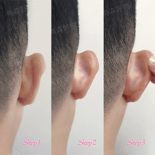 神器招风秒变定型耳贴