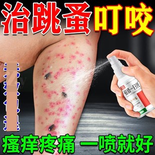 人用跳蚤特效药虫卵双杀驱灭阴虱专用喷雾咬止痒膏神器一扫光正品