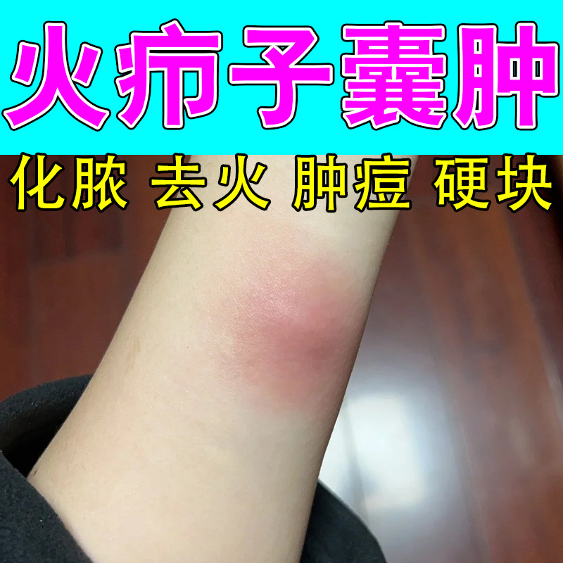 上火疖子红肿身上红疙瘩火疖子草本温和修护疙瘩痘保湿舒缓膏