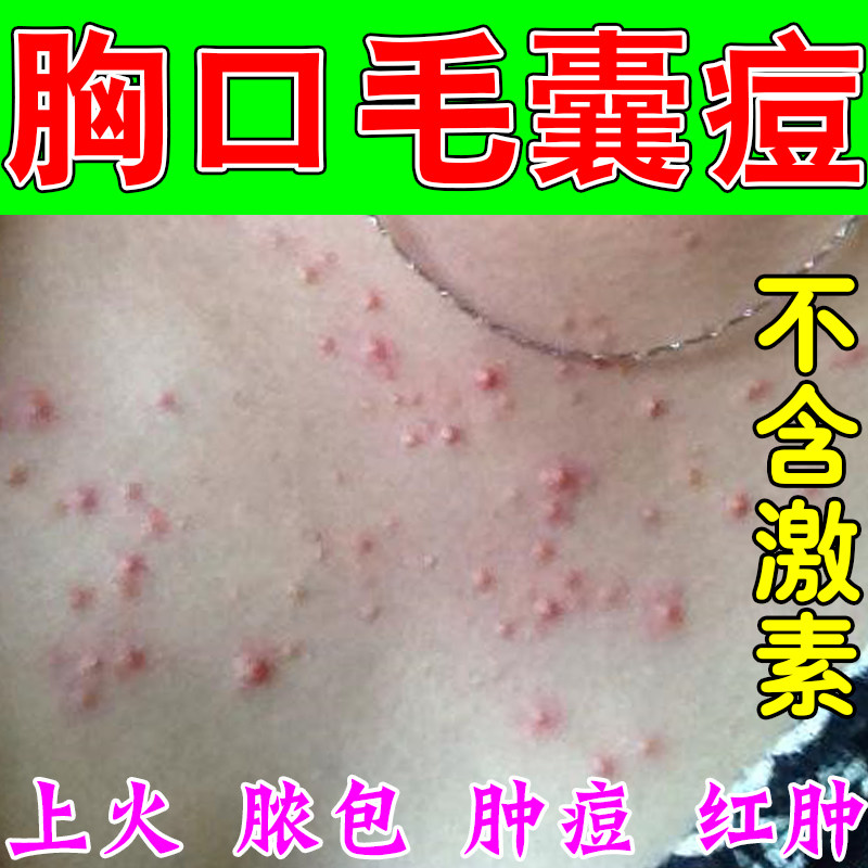 前胸长痘疙瘩毛囊堵塞胸前毛囊疙瘩密集泛红粗糙肌肤身体修护膏