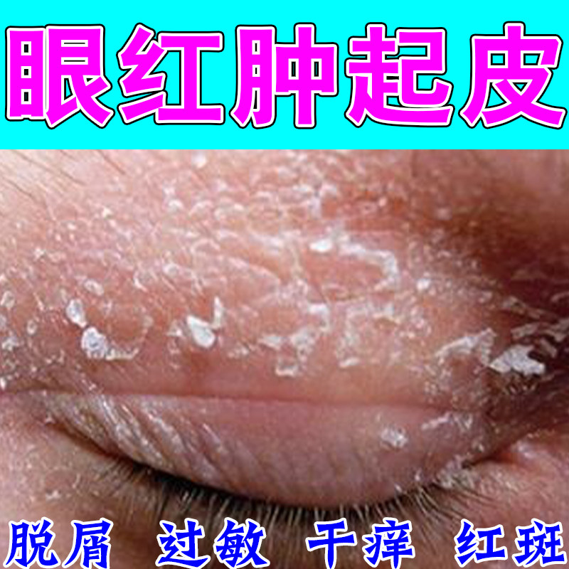 眼皮红肿起皮痒眼睛周围过敏粗糙发痒干燥起皮神经性保湿草本乳膏