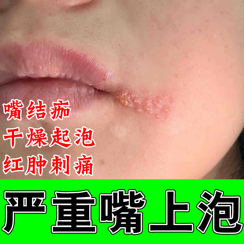 嘴角起泡发黄干疼嘴唇干燥起泡口角开裂舒缓唇部泛红干痛修复膏